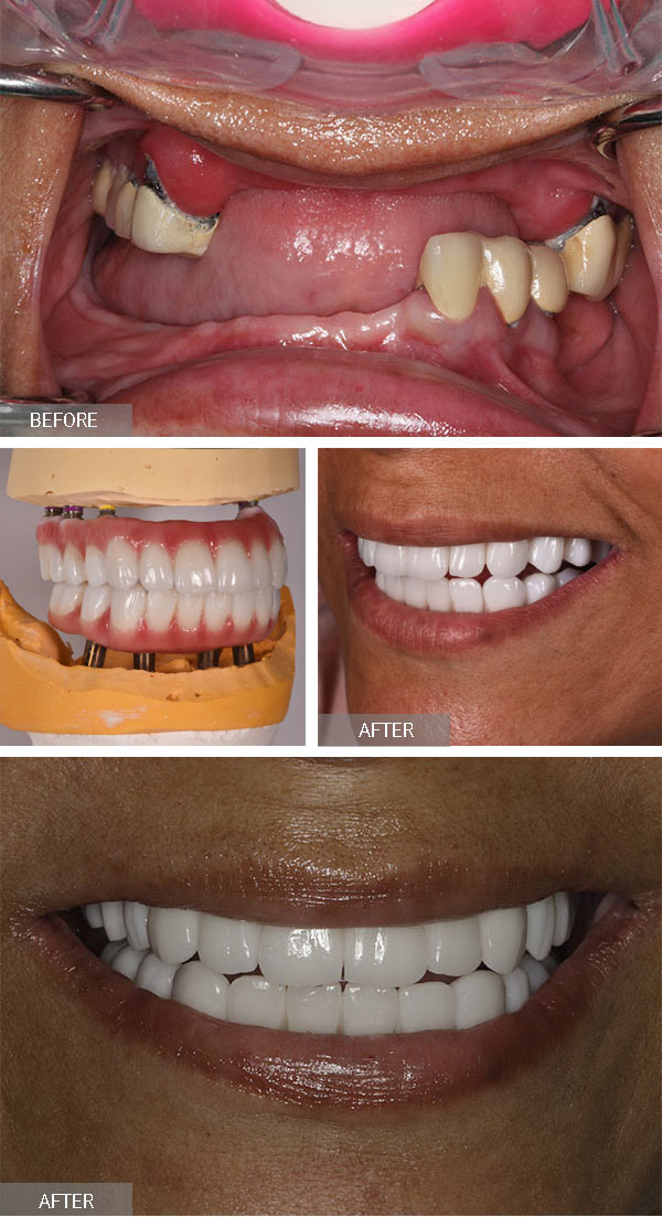 40+ All on 4 vorher nachher bilder , All on 4 Dental Implants in NYC Implant Dentures Manhattan NY