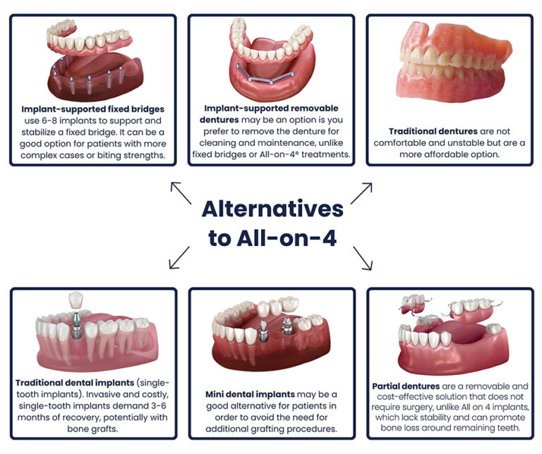 Allon4 Dental Implants NYC Implant Dentures New York City