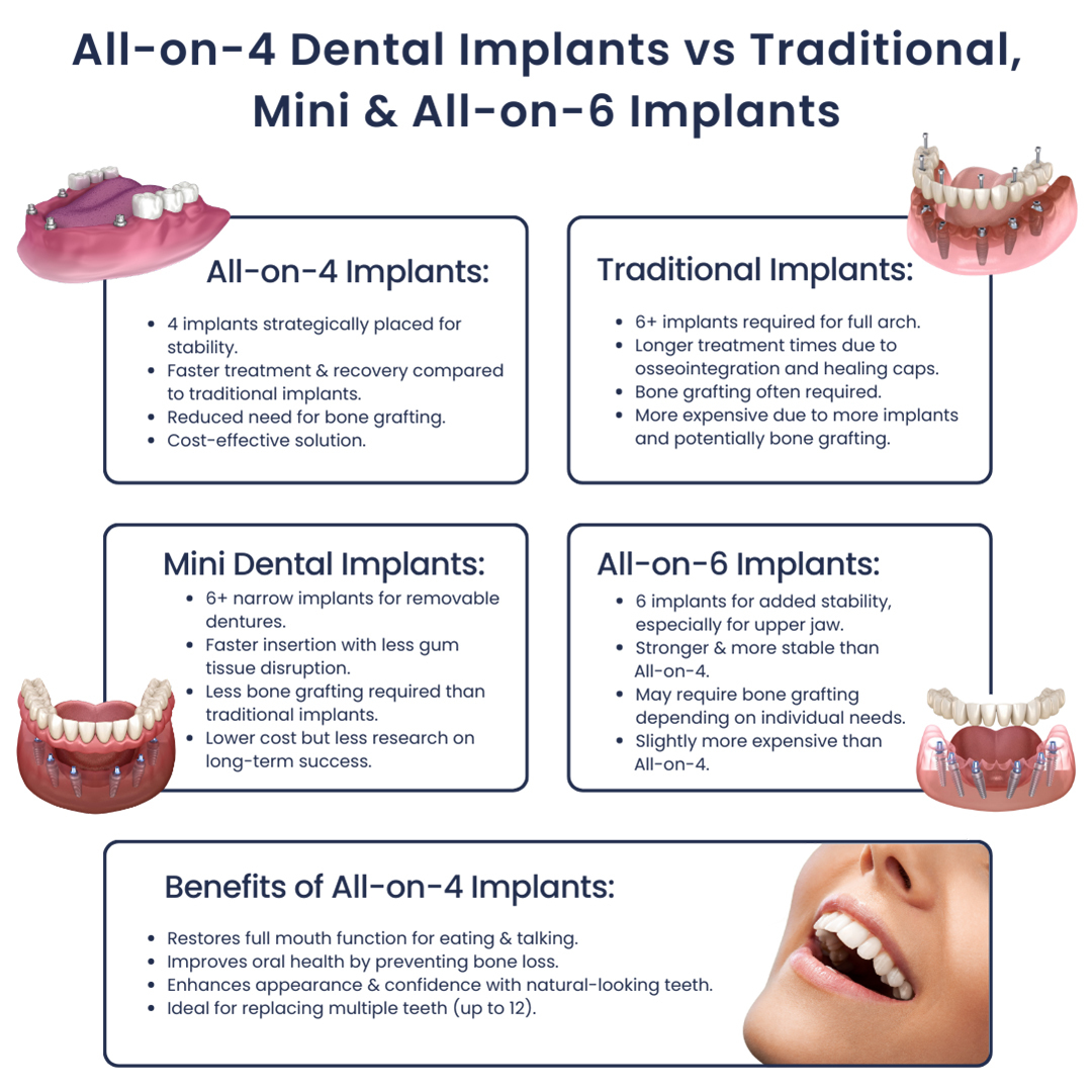 Comparison of All-on-4 Dental Implants