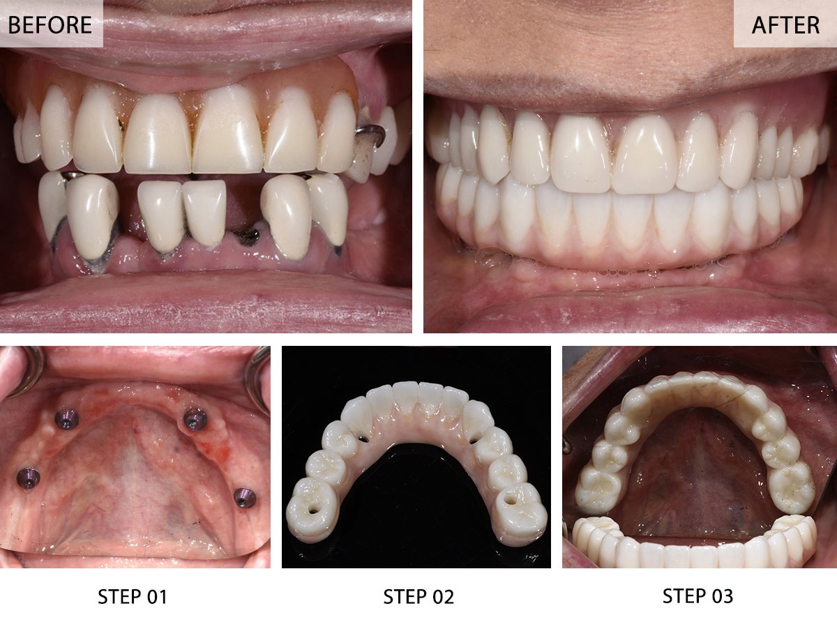 All-on-4 Dental Implants Before and After Pictures (Case 1) - Step-by-Step Transformation Gallery