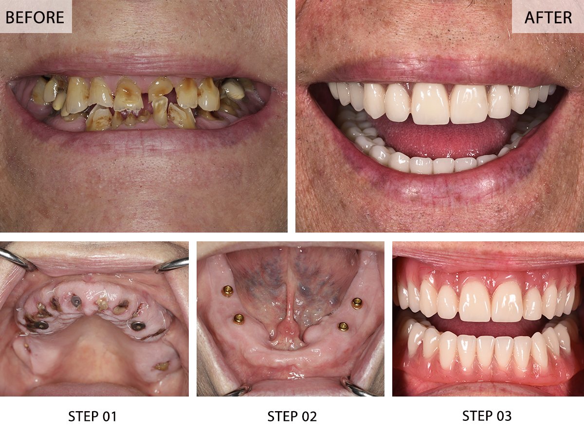 All-on-4 Dental Implants Before and After Pictures (Case 2) - Step-by-Step Transformation Gallery