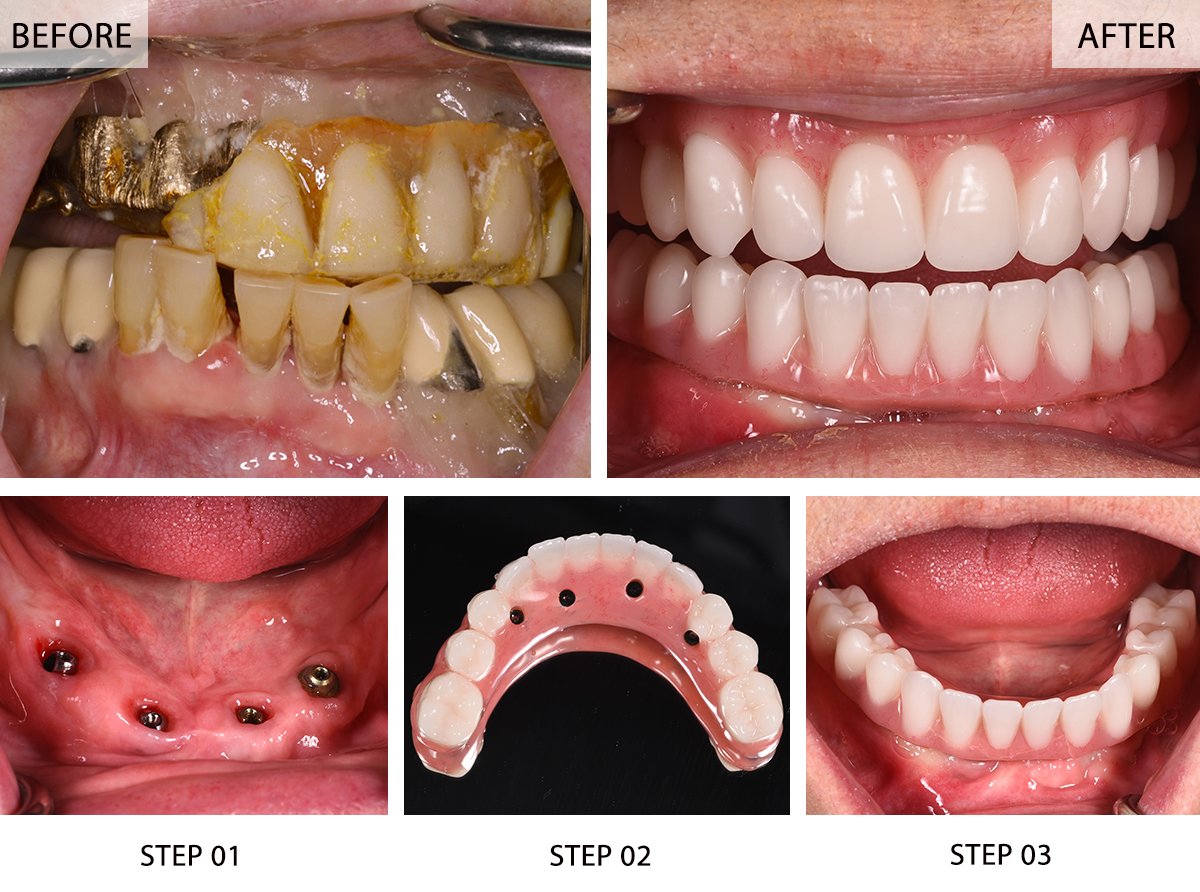 All-on-4 Dental Implants Before and After Pictures (Case 3) - Step-by-Step Transformation Gallery