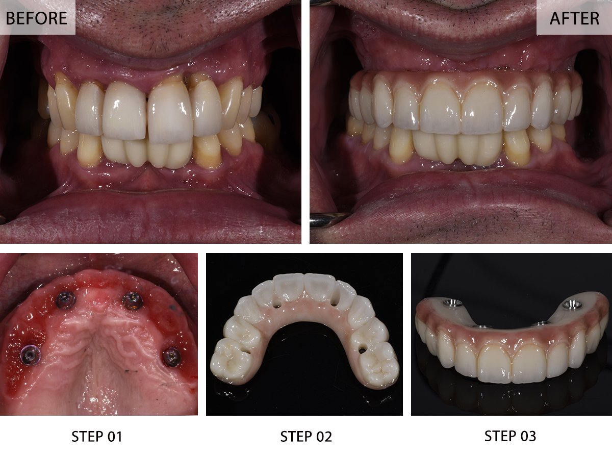 All-on-4 Dental Implants Before and After Pictures (Case 4) - Step-by-Step Transformation Gallery