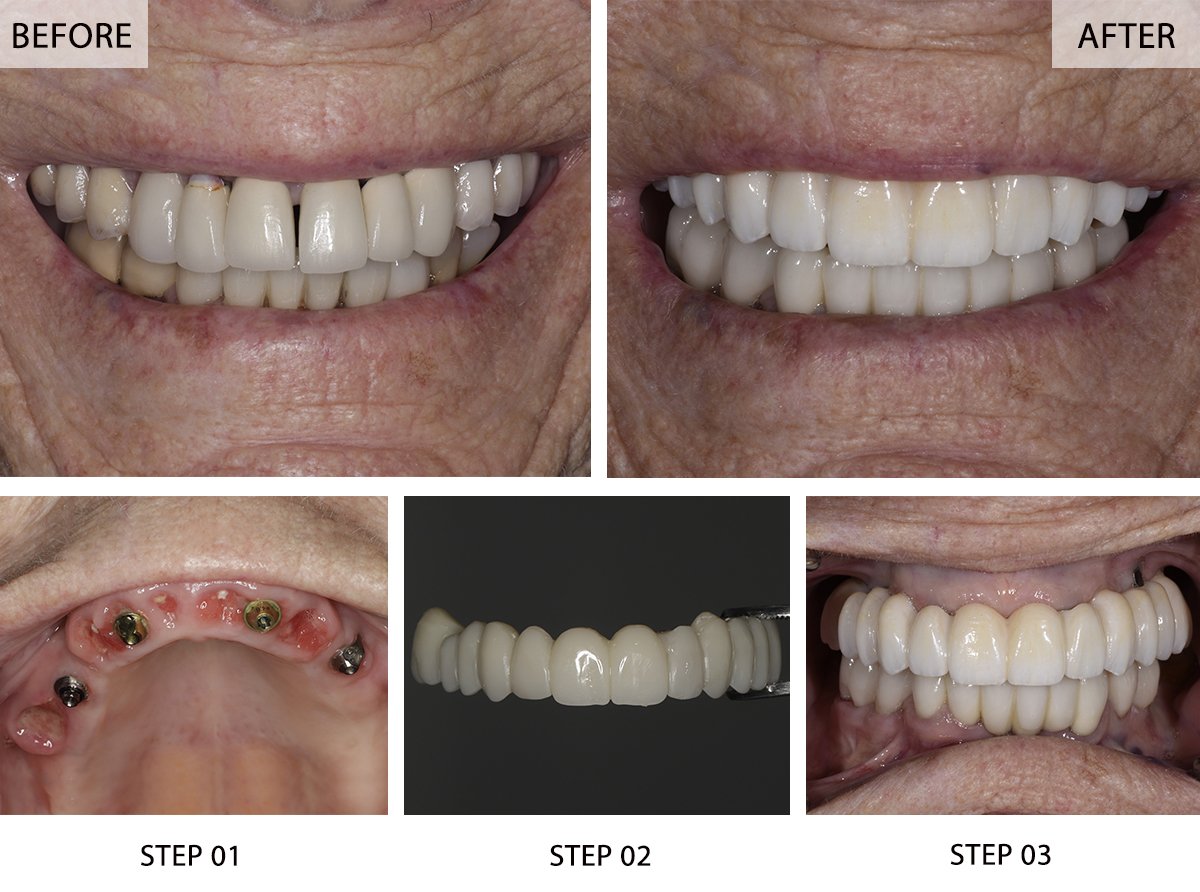 All-on-4 Dental Implants Before and After Pictures (Case 5) - Step-by-Step Transformation Gallery