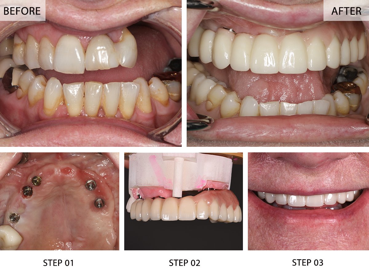 All-on-5 Dental Implants Before and After Pictures (Case 1) - Step-by-Step Transformation Gallery