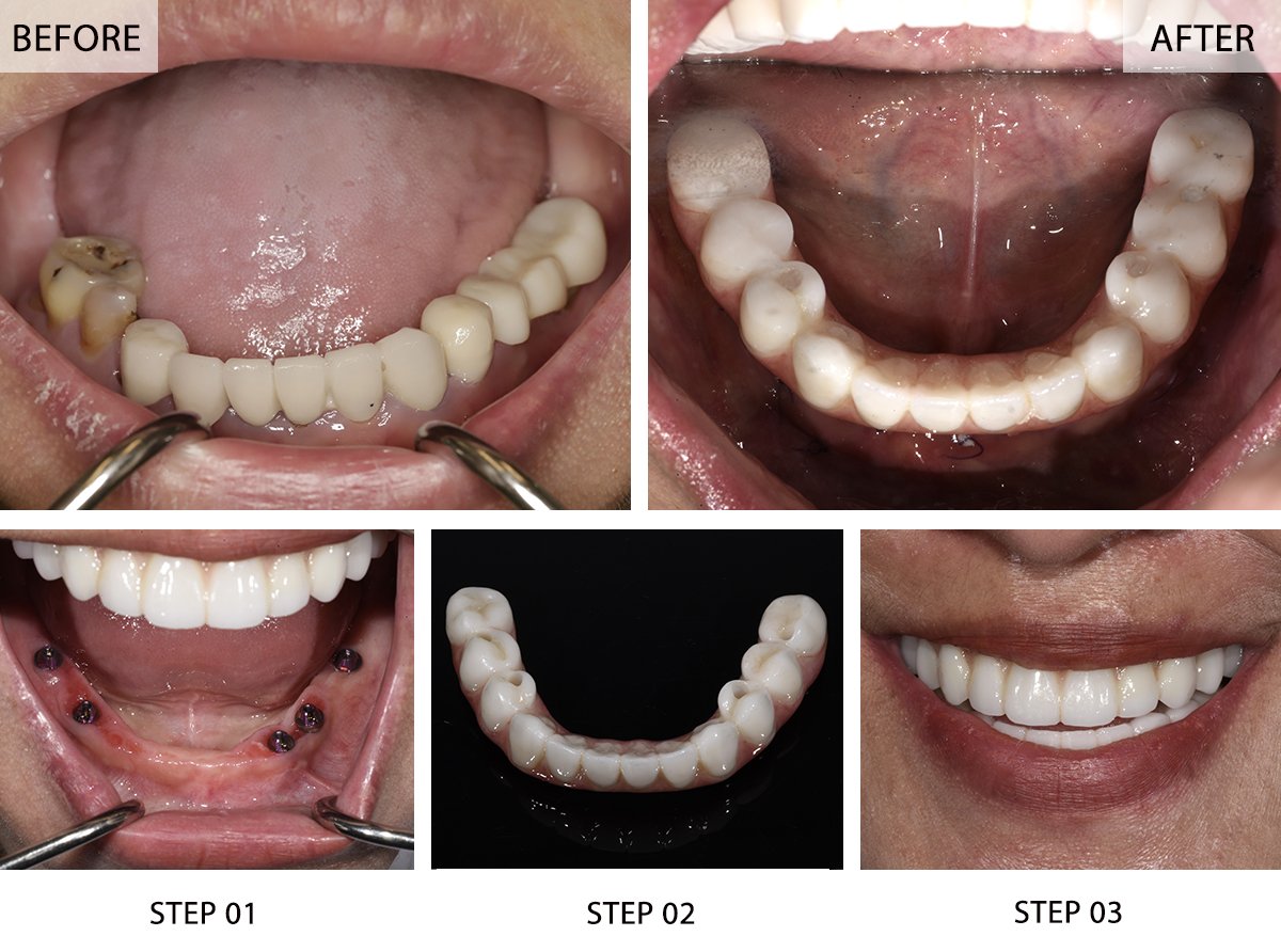 All-on-5 Dental Implants Before and After Pictures (Case 2) - Step-by-Step Transformation Gallery