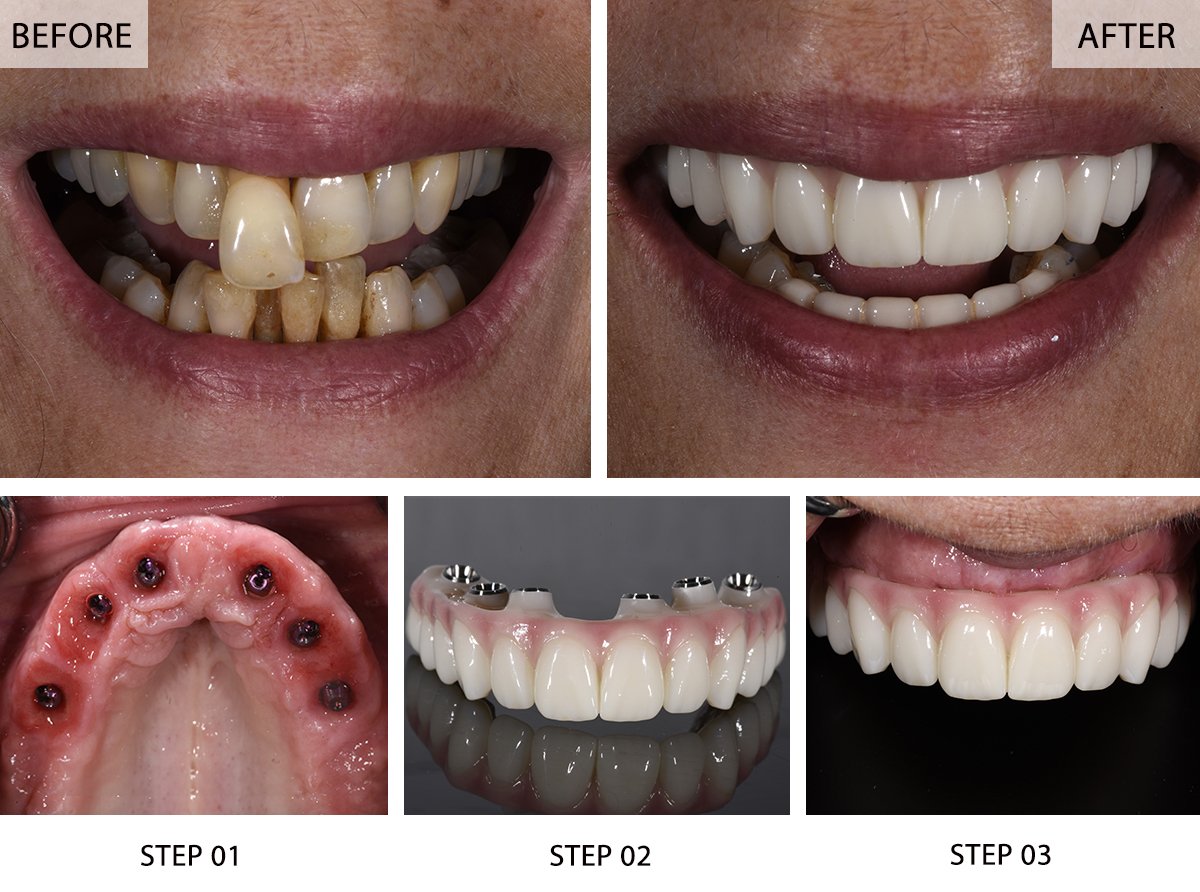 All-on-6 Dental Implants Before and After Pictures (Case 1) - Step-by-Step Transformation Gallery