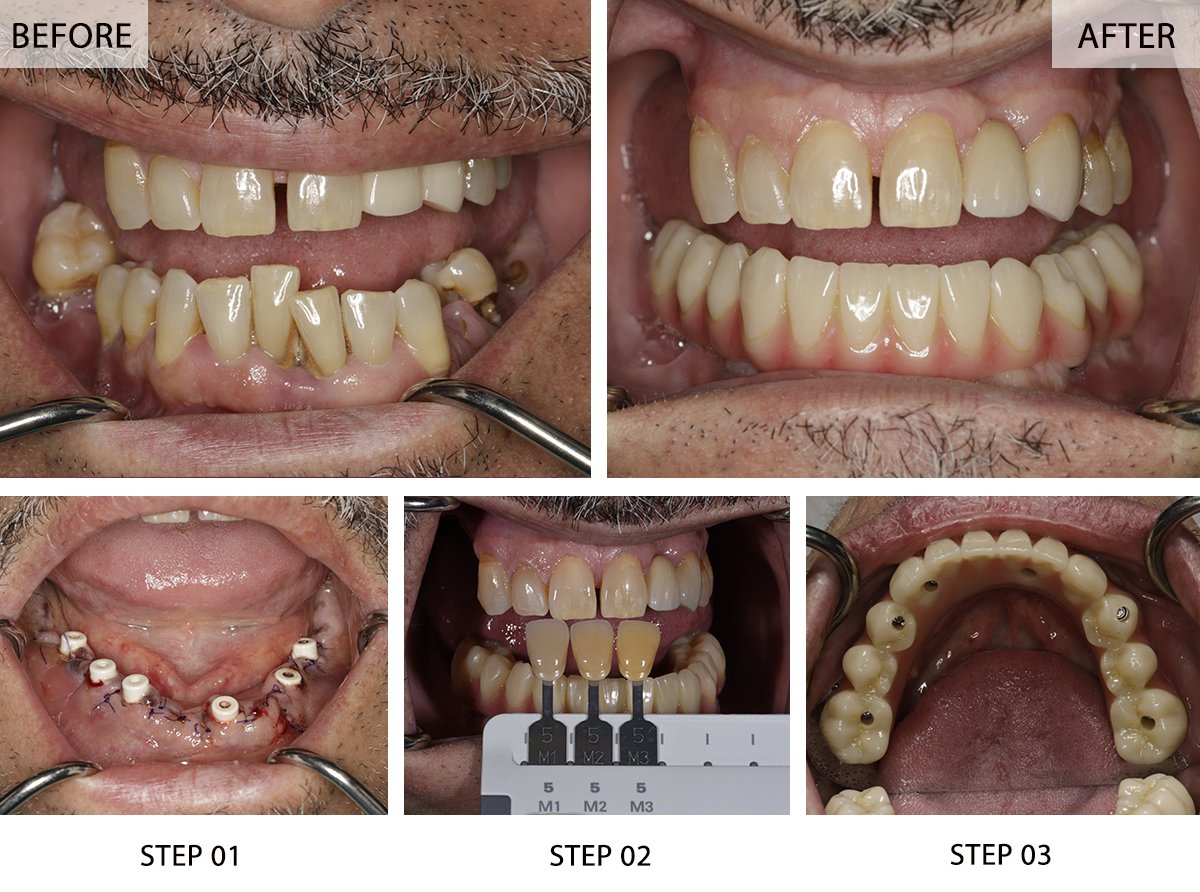 All-on-6 Dental Implants Before and After Pictures (Case 2) - Step-by-Step Transformation Gallery