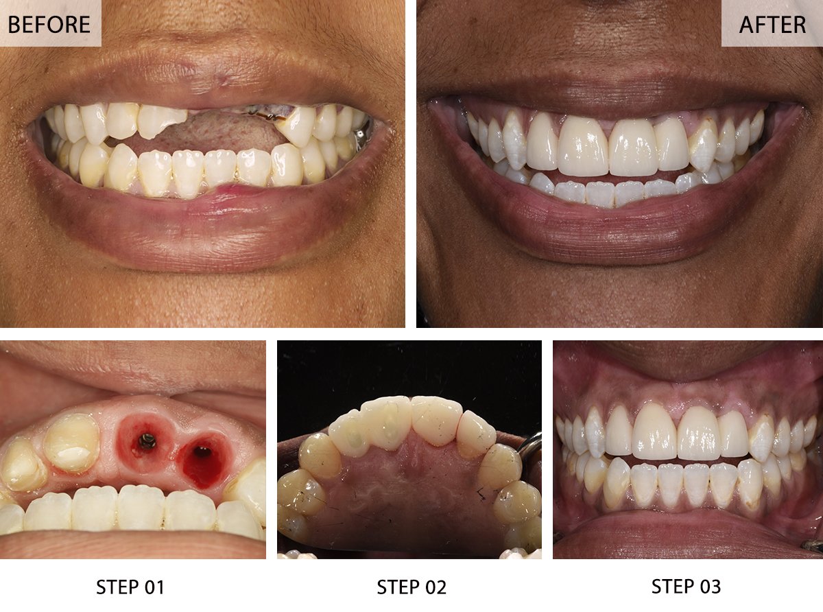 Dental Implant Vs Bridge